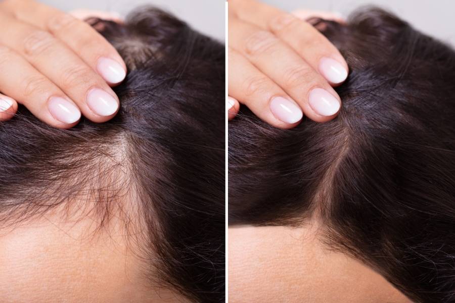 Antes e depois da queda de cabelo.