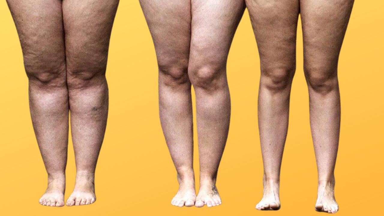 lipedema
