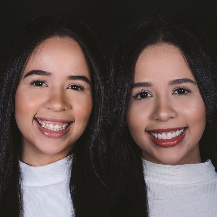 Fotos de antes e depois de lente de contato nos dentes de Laura Brito