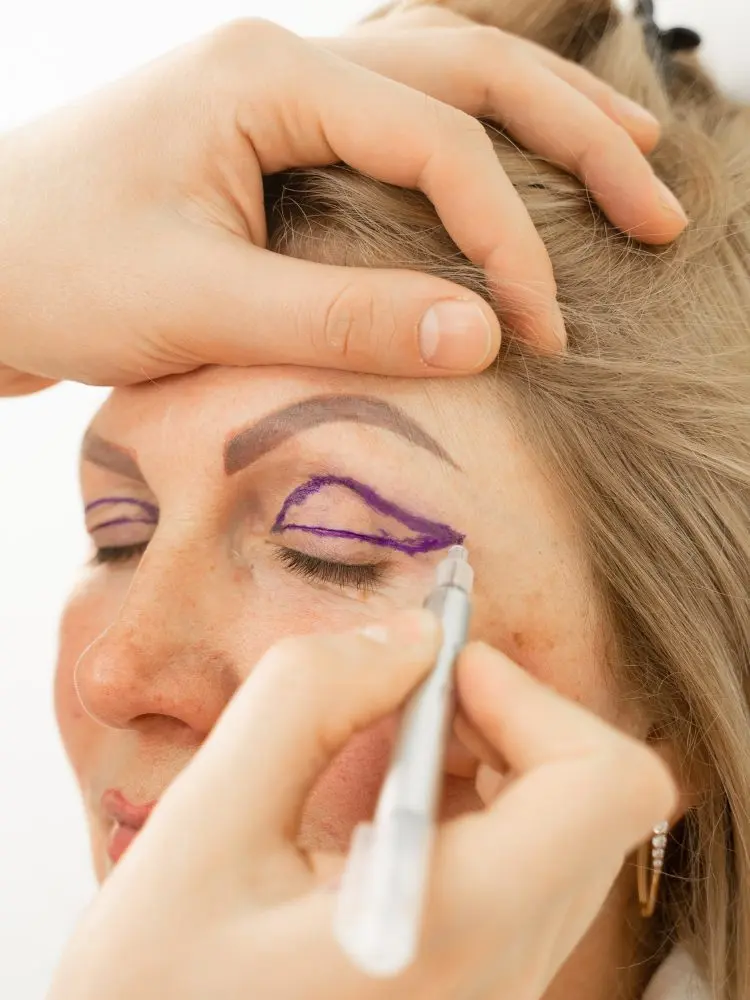Senhora de pele clara de olhos fechados enquanto mãos de pele clara, com caneta, desenham traçado da blefaroplastia