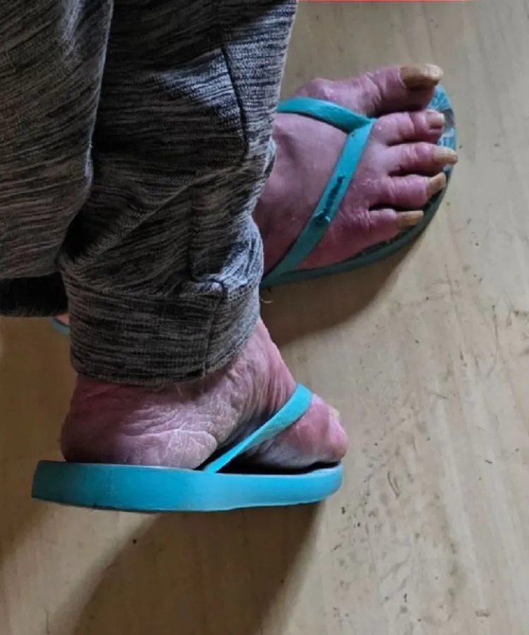 Dois pés com a pele enrugada e unhas muito longas, calçando chinelos de dedo azuis, em um piso de madeira. A pessoa usa calças cinzas.