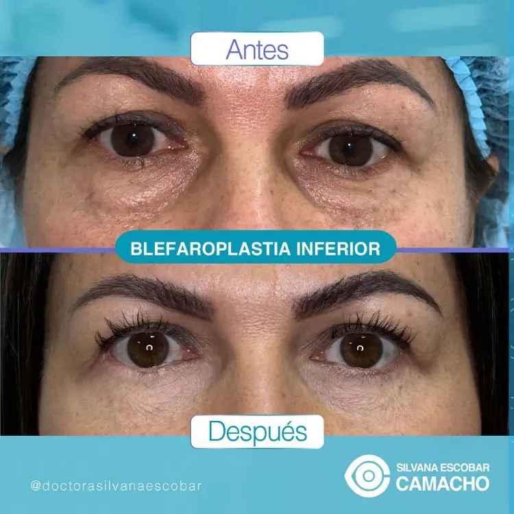 Antes e depois de blefaroplastia na pálpebra inferior em mulher de pele clara 