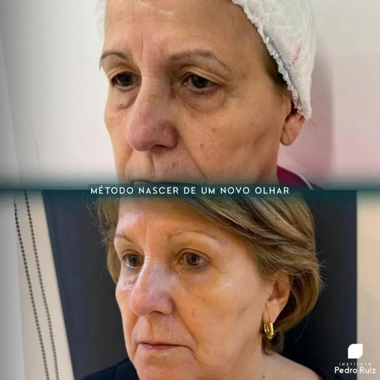 Antes e depois de blefaroplastia superior e inferior em senhora de pele clara 