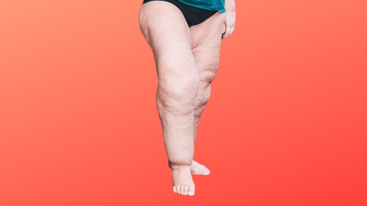 exemplo lipedema 