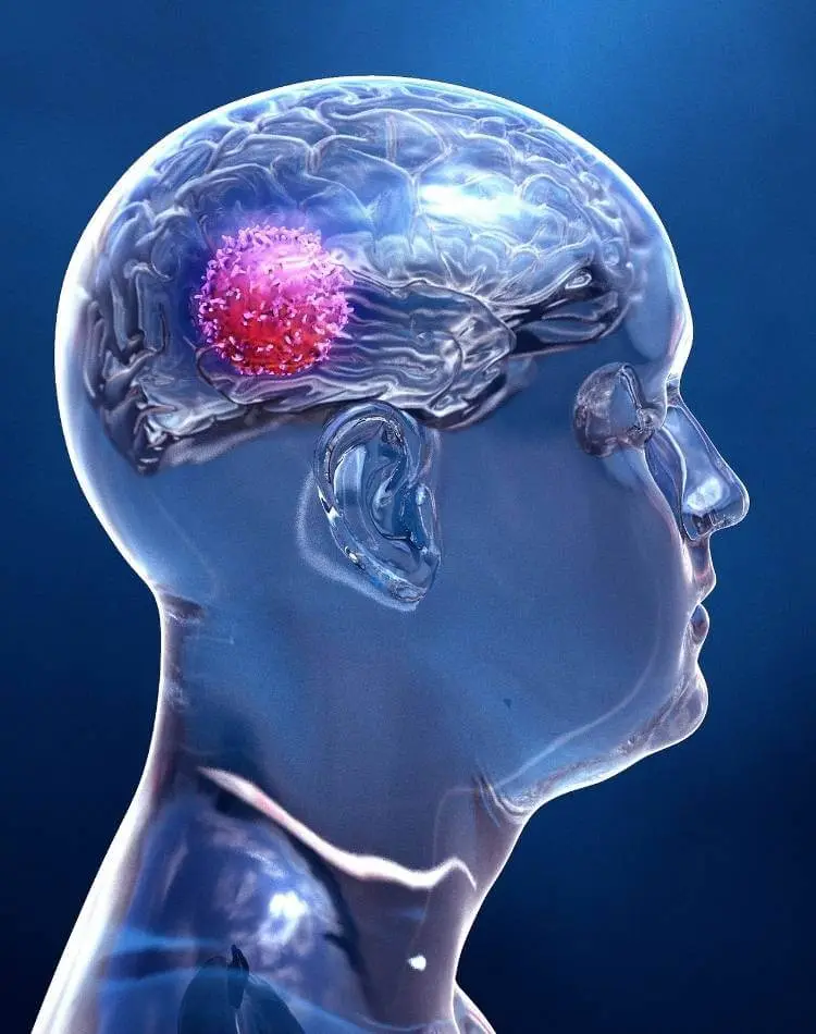 Tumor cerebral é uma das causas da afasia.