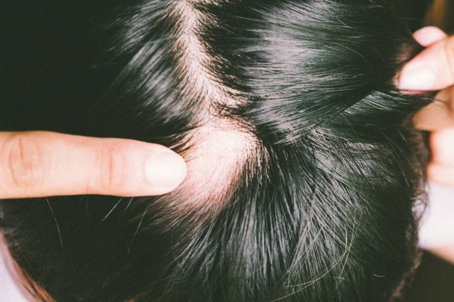 Homem com buraco sem cabelo causado pela alopecia areata.