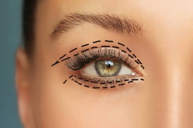 Foto de perto do olho de uma pessoa. A pessoa tem olhos esverdeados e sobrancelhas escuras. A pálpebra da pessoa tem linhas pretas pontilhadas desenhadas sobre ela, indicando uma cirurgia de Blefaroplastia. 