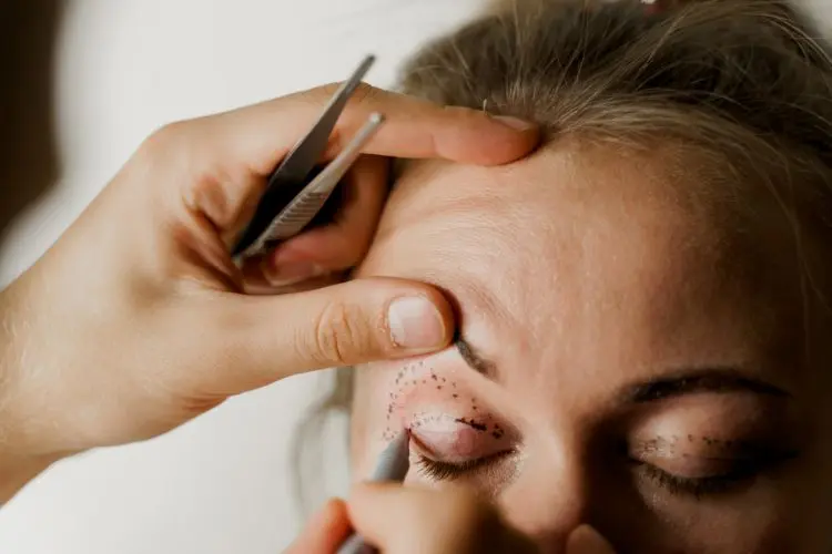 Imagem de uma pessoa realizando um procedimento de blefaroplastia. Outra pessoa está segurando uma pinça de metal usando uma pinça de metal. A pinça está próxima à sobrancelha da pessoa, que está levemente arqueada. Na outra mão, a pessoa usa uma caneta e desenha sobre a pálpebra da paciente.