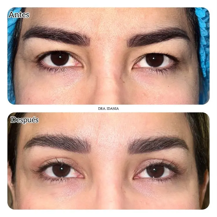 Antes e depois de blefaroplastia na pálpebra superior em mulher de pele clara
