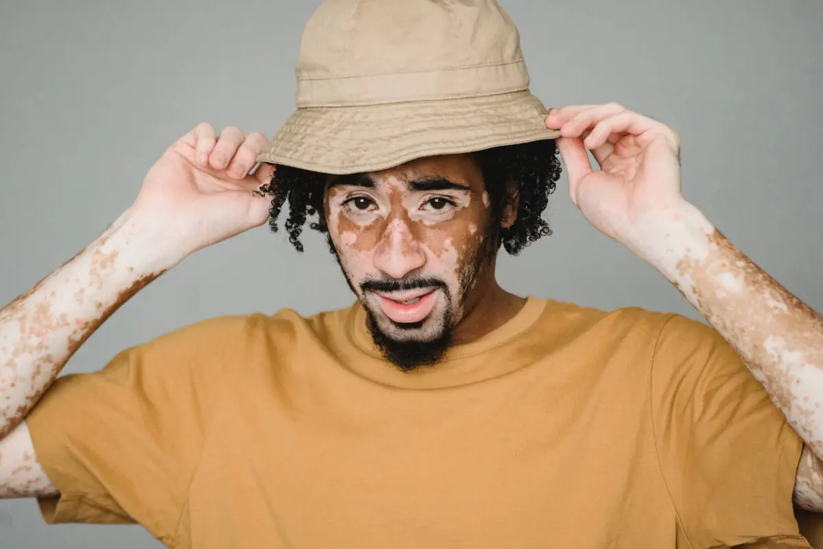 Homem com vitiligo.