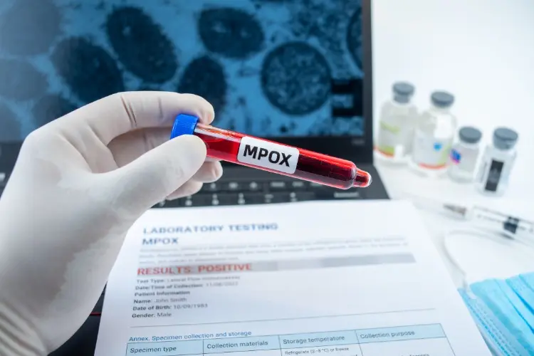 Foto de médico com luva segurando amostra escrito "mpox" e resultado positivo do exame ao fundo