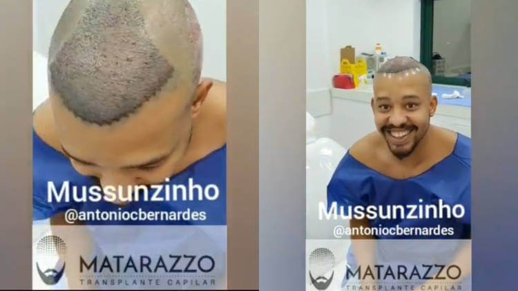 Procedimento Capilar Mussunzinho