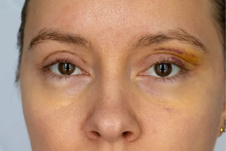 Pós-cirurgia de blefaroplastia. Mulher de pele clara sem os pontos nas pálpebras, apenas com a pele um pouco amarelada e roxa.