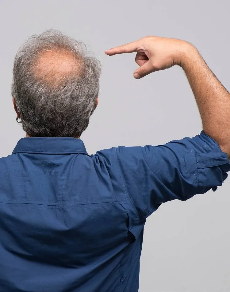 Homem com alopecia androgenética. Homem mostrando calvície.