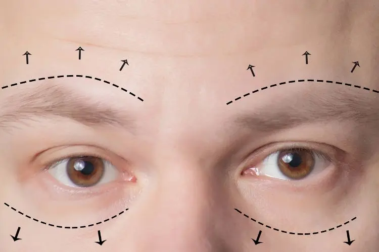 Imagem de olhos e testa de uma pessoa. A imagem foi editada para mostrar linhas pontilhadas e setas ao redor dos olhos. As linhas pontilhadas e setas indicam as áreas onde a Blefaroplastia, um tipo de cirurgia plástica, pode ser realizada. A pessoa tem olhos castanhos e a pele ao redor dos olhos é clara.