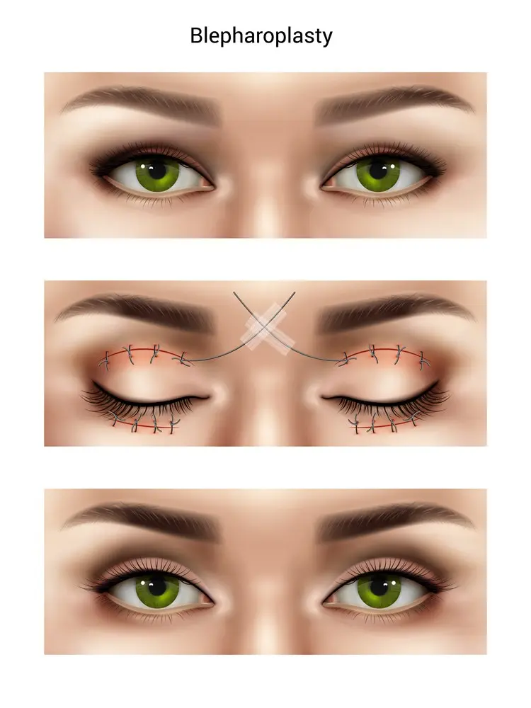 Ilustração de como é feira a cirurgia Blefaroplastia. 3 etapas, antes (com as pálpebras caídas), durante (com os pontos cirúrgicos), depois (resultado dos olhos mais levantados)