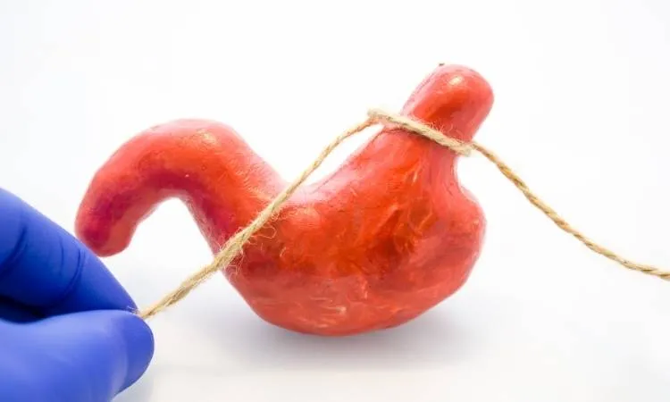 foto de mão com luvas azuis amarrando uma escultura de estômago com um barbante, hérnia de hiato.