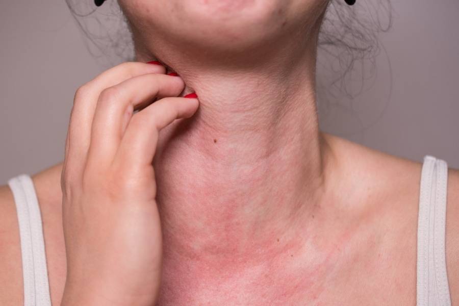 Mulher com alergia de unhas artificiais.